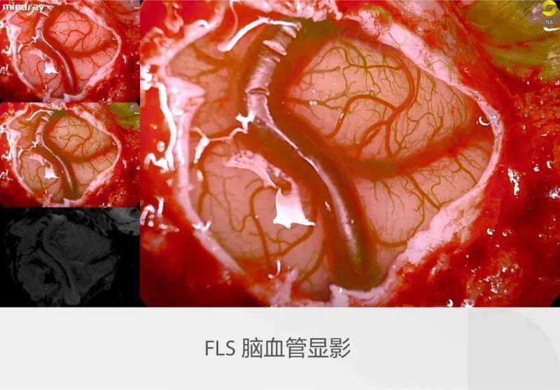 迈瑞全域荧光智能影像平台,探索精准外科未达之“镜” 新闻 迈瑞全域荧光智能影像平台,探索精准外科未达之“镜” 新闻