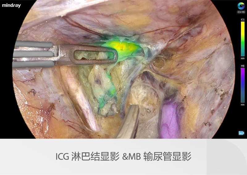 迈瑞全域荧光智能影像平台,探索精准外科未达之“镜” 新闻 迈瑞全域荧光智能影像平台,探索精准外科未达之“镜” 新闻